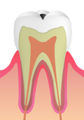 初期虫歯