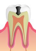 進行した虫歯