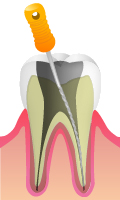 根管治療