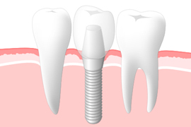 インプラント治療